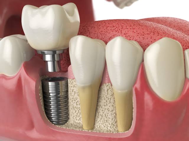 Dental implants and implant dentistry