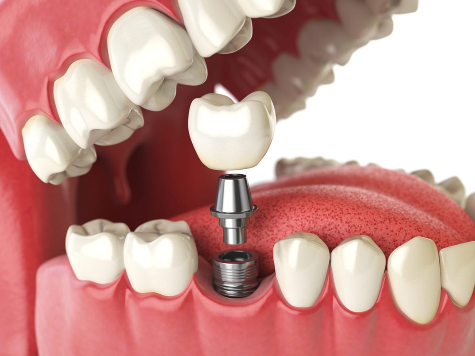 Dental implant consultation and care