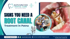 Signs You May Need a Root Canal in Patna