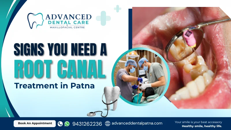 Signs You May Need a Root Canal in Patna